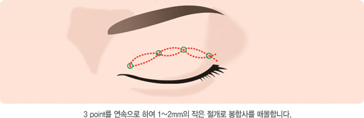 3 point를 연속으로 하여 1~2mm의 작은 절개로 봉합사를 매몰합니다.