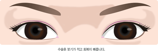 수술후 붓기가 적고 회복이 빠릅니다.