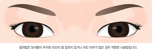 절개법은 눈꺼풀이 두꺼워 라인이 잘 잡히지 않거나 처진 피부가 많은 경우 적합한 시술법입니다.