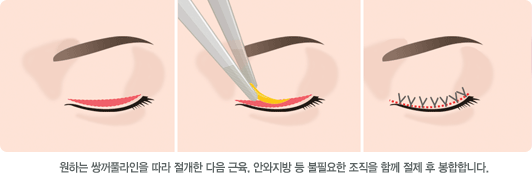 원하는 쌍꺼풀라인을 따라 절개한 다음 근육, 안와지방 등 불필요한 조직을 함께 절제 후 봉합합니다.