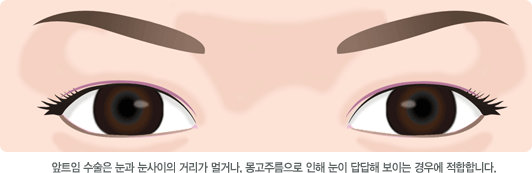 앞트임 수술은 눈과 눈사이의 거리가 멀거나, 몽고주름으로 인해 눈이 답답해 보이는 경우에 적합합니다.