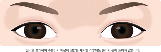 점막을 절개하여 수술하기 때문에 실밥을 제거한 직후에도 흉터가 눈에 뜨이지 않습니다.