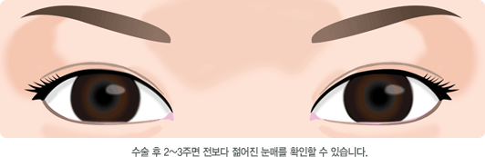 수술 후 2~3주면 전보다 젊어진 눈매를 확인할 수 있습니다.