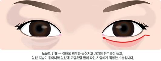 노화로 인해 눈 아래쪽 피부가 늘어지고 처지며 잔주름이 늘고, 눈밑 지방이 튀어나와 눈밑에 고랑처럼 골이 파인 사람에게 적합한 수술입니다.