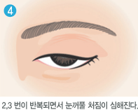 2,3 번이 반복되면서 눈꺼풀 처짐이 심해진다. 