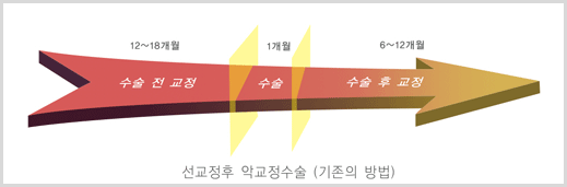 선교정후 악교정수술(기존의방법)