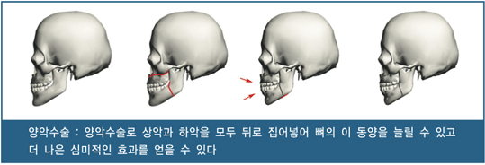 양악수술 : 양악수술로 상악과 하악을 모두 뒤로 집어넣어 뼈의 이 동양을 늘릴 수 있고 더 나은 심미적인 효과를 얻을 수 있다.