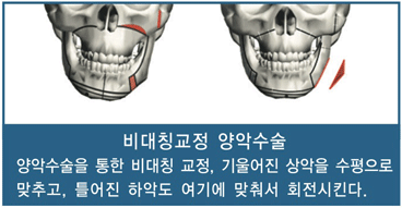 비대칭교정 양악수술-양악수술을 통한 비대칭 교정, 기울어진 상악을 수평으로 맞추고, 틀어진 하악도 여기에 맞춰서 회전시킨다.