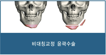 비대칭교정 윤곽수술