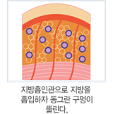 지방흡인관으로 지방을 흡입하자 동그란 구멍이 뚤린다.